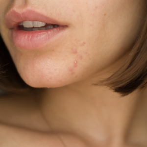 Herramientas efectivas para combatir el acné hormonal: Guía Completa